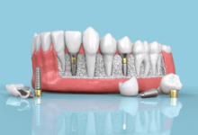 Understanding the Long-Term Comfort of Dental Implants