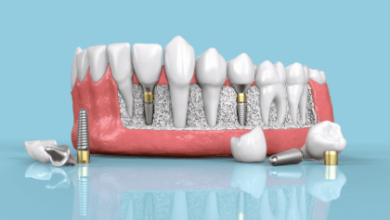 Understanding the Long-Term Comfort of Dental Implants